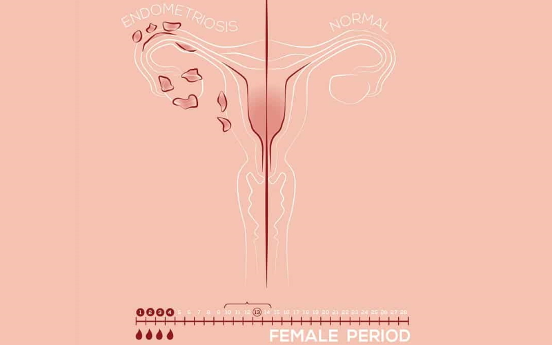 Иллюстрация эндометриоза, ткани эндометрия в матке.