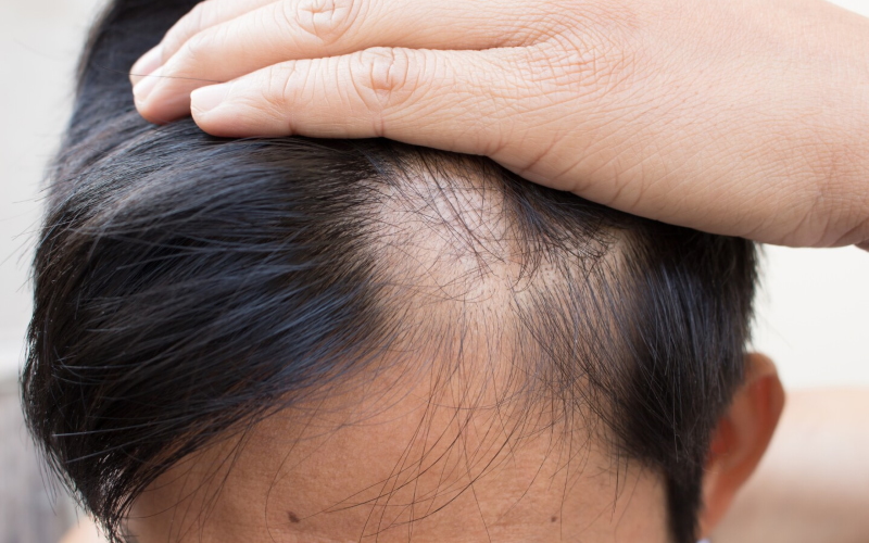 Распространенное лекарство от артрита показало себя многообещающим в лечении очаговой алопеции, вызывающей очаговое выпадение волос.